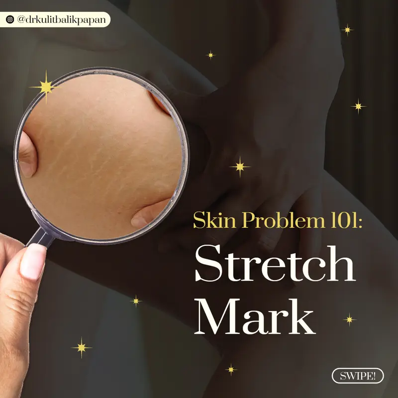 Contoh desain konten Skin Problem 101 Stretch Mark Dr Kulit Balikpapan