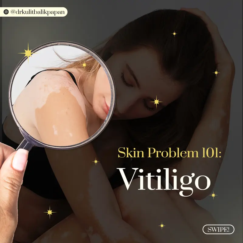 Contoh desain konten Skin Problem 101 Vitiligo Dr Kulit Balikpapan