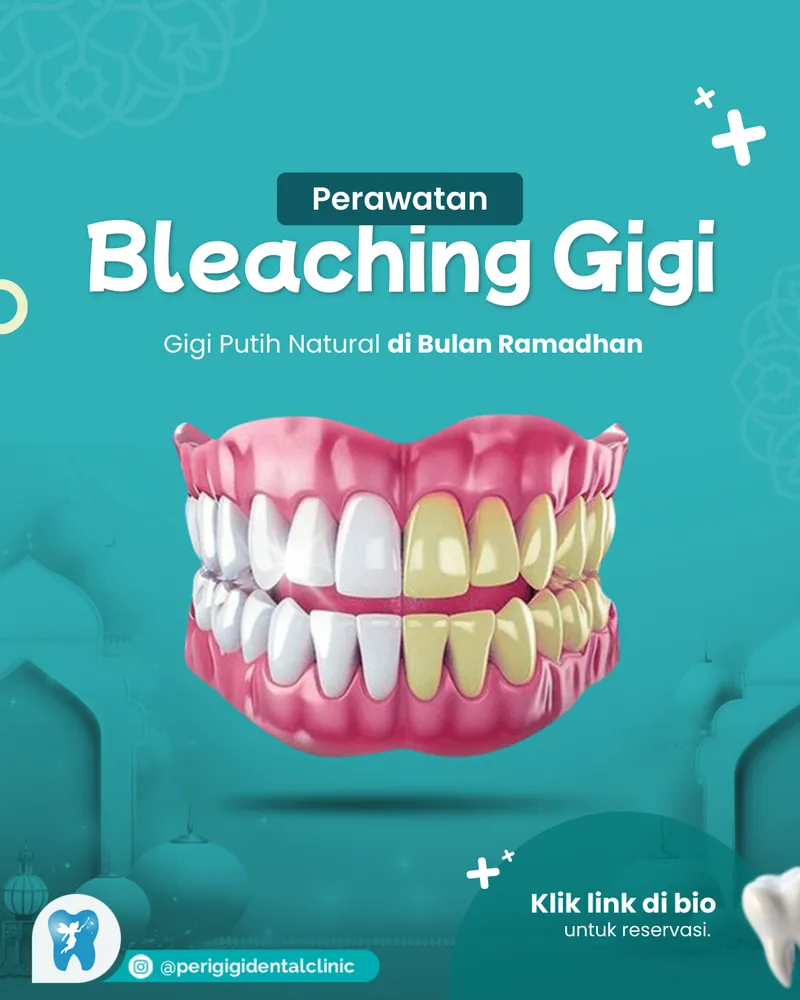 Desain konten promosi perawatan bleaching gigi untuk Instagram Perigi Dental oleh Creativism